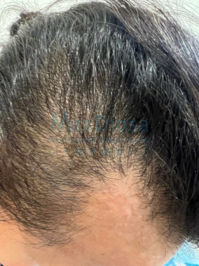 斑禿治療後